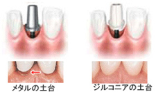 インプラント治療とは